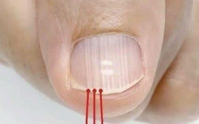 If Lines Start Appearing On Your Nails After 40, It Could Be A Warning Sign…