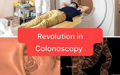 New method, colonoscopy will no longer be an invasive test