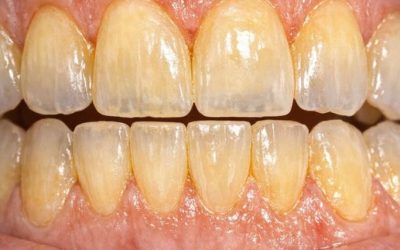 My teeth keep getting more yellow even though I brush twice a day. Why won’t they stay white?