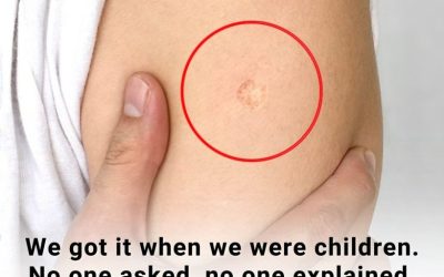 The Truth Behind the Mysterious Round Scar on the Upper Arm