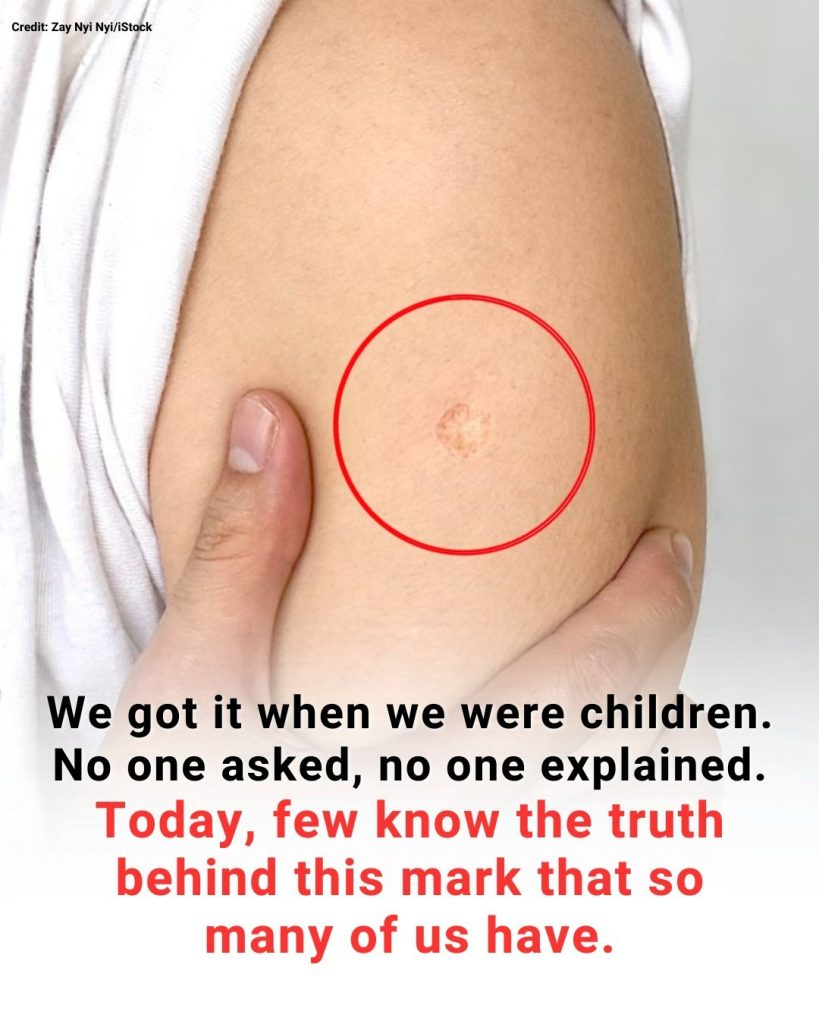 The Truth Behind the Mysterious Round Scar on the Upper Arm
