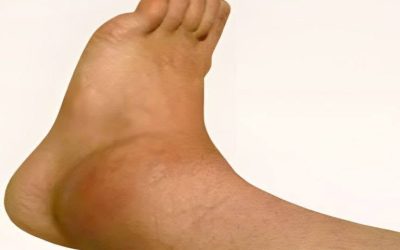 Swollen Ankles and Feet Explained: Causes Revealed!