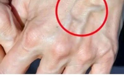 Si vos veines sont visibles, voici ce que cela peut signifier