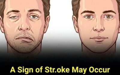 This Early Warning Sign Could Signal a Future Stroke – Here’s What to Watch For