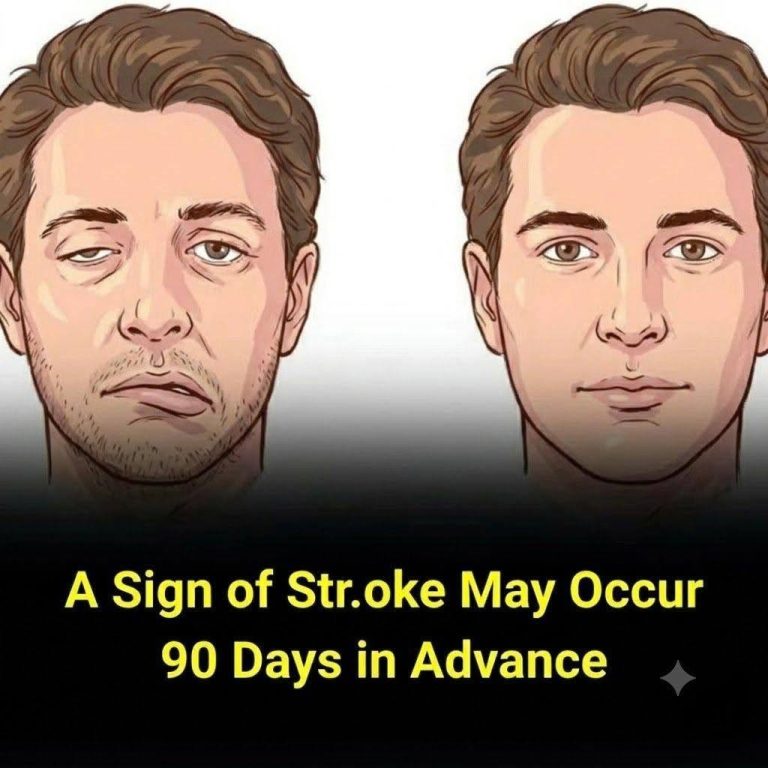 This Early Warning Sign Could Signal a Future Stroke – Here’s What to Watch For